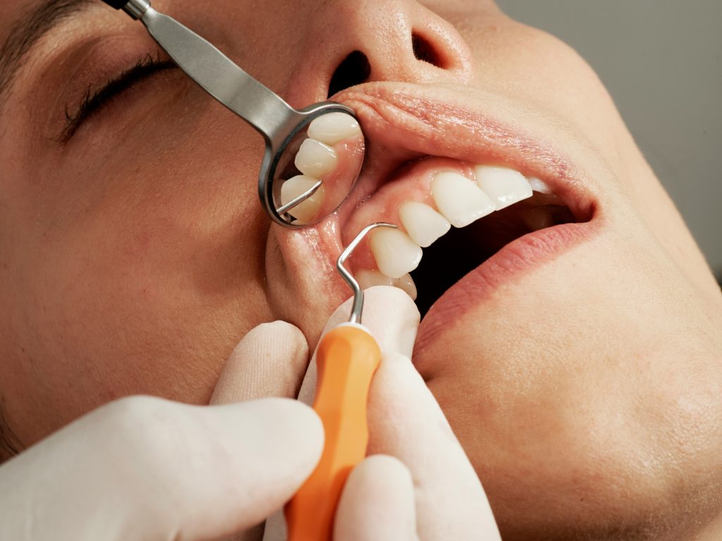 dental-scaling